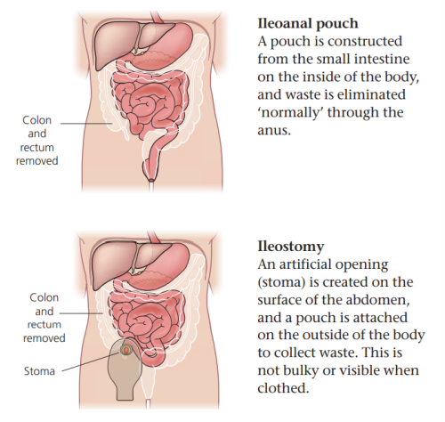 Ileoanal pouch / Ileostomy