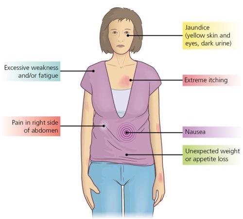 Symptoms of cholangiocarcinoma