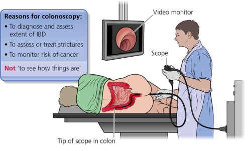 colonoscopy scope